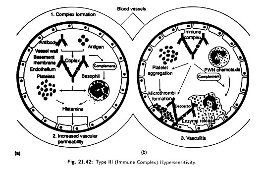 Type III (immune complex) Hypersensitivity 