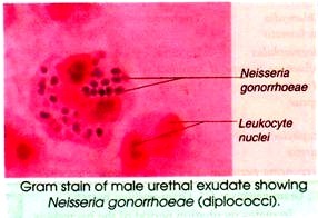 Gram stain of male urethal exudate showing Neisseria gonorrhoeae 