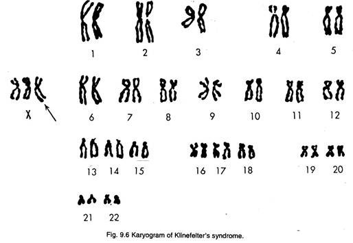 Karyogram of kilneflter 's syndrome