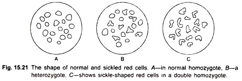The shape of normal and sickled red cells